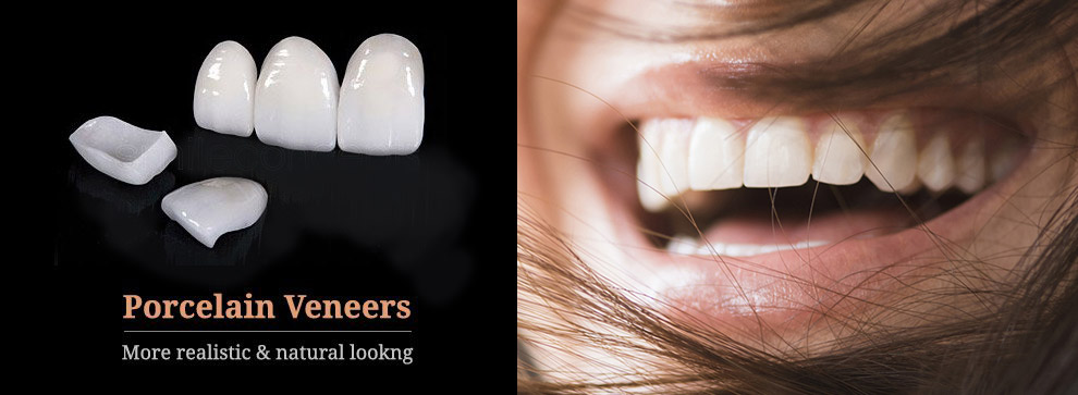 veneers, dental, teeth, cosmetic dentistry