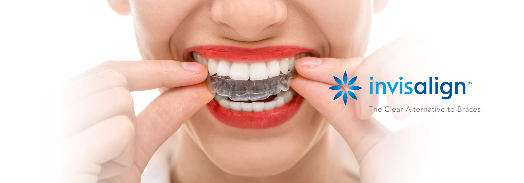 Invisalign, Invisalign treatment, Invisalign in georgia, georgia country, Does Invisalign work, Will Invisalign work for me? How long does Invisalign take? Invisaliagn Georgia, Invisalaign Tbilisi, Invisalaign, Invisalaign treatment, why choose Invisalign, Invisalign in Tbilisi, invisalign treatment in Georgia country, Invisalign