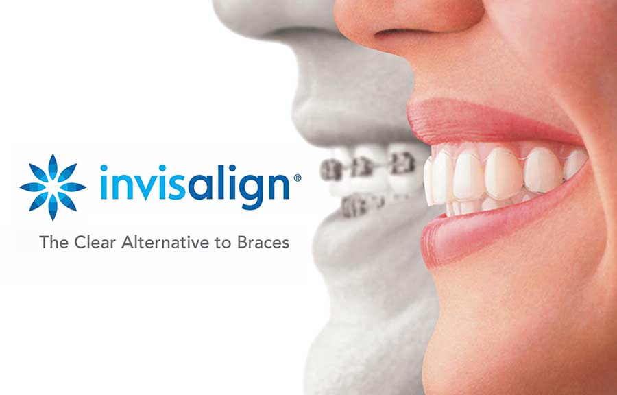 Invisalign Invisalign