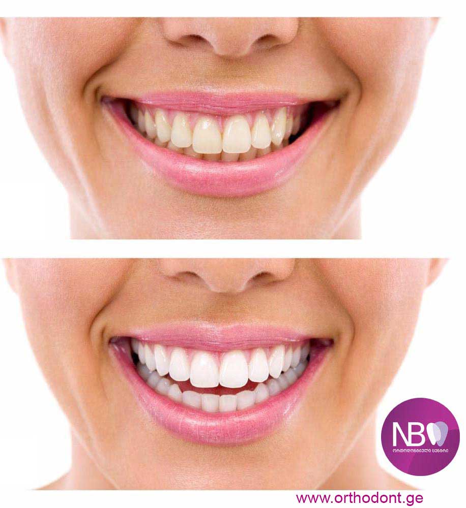 კბილების გათეთრება კბილების გაწმენდა, ლაზერით გათეთრება კაპებით გათეთრება, პროფესიული წმენდა, ნადები და ქვები პოლირება